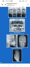 Оптг рентген стоматологический, ортопантомограф