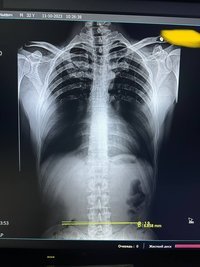 Переносной рентгеновский аппарат Econet meX+100