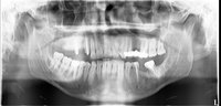 Ортопантомограф стоматологический Progeny Vantage 2011 г.в.