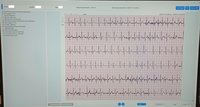 Холтер Монитор ЭКГ Wellue + AI-ECG Analysis System