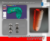 Дентальные имплантаты КОНМЕТ: комплексное решение для стоматологов