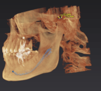 КТ OP 3D 9*14 с цефалостатом (pan,ceph,3D)
