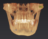 КТ OP 3D 9*14 с цефалостатом (pan,ceph,3D)