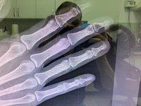 Портативный рентген Арман 10л01 с оцифровщиком CR10х и ПК