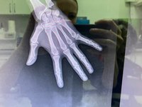 Портативный рентген Арман 10л01 с оцифровщиком CR10х и ПК