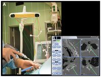 Система хирургическая навигационная Brainlab Kolibri с комплектом камер Optical surgical navigation system