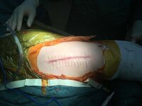 Пластырь для скрепления краев раны без наложения швов SKIN-FIX