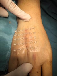Пластырь для скрепления краев раны без наложения швов SKIN-FIX